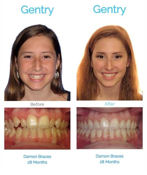 1 month braces transformation|The Braces Process: Before and After Transformation Journey.